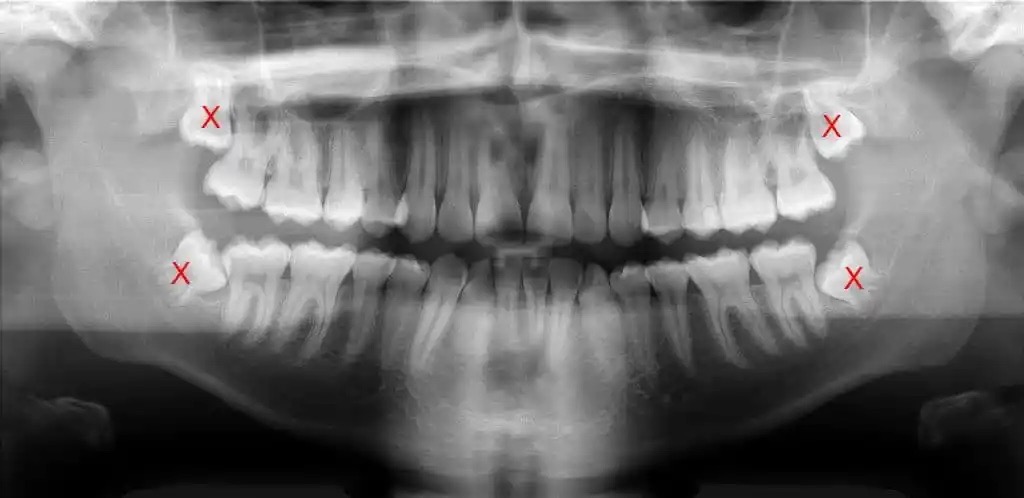 X-ray image of impacted wisdom teeth